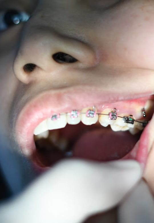Close-up of teeth with orthodontic braces