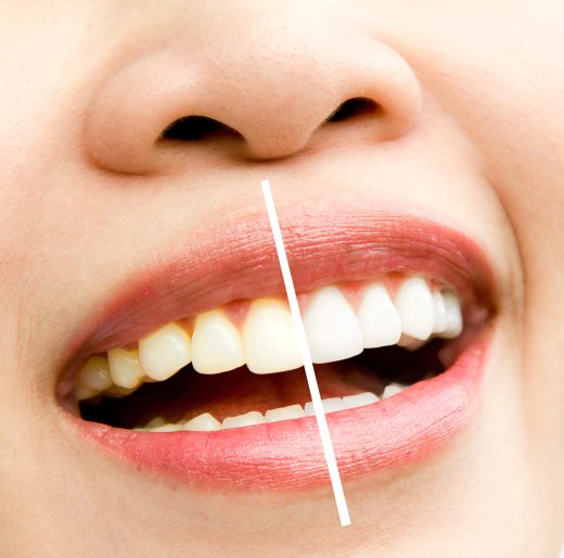 Close-up of a smile showing teeth before and after whitening